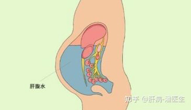 丙肝治愈不再是梦：科学与医学的进步